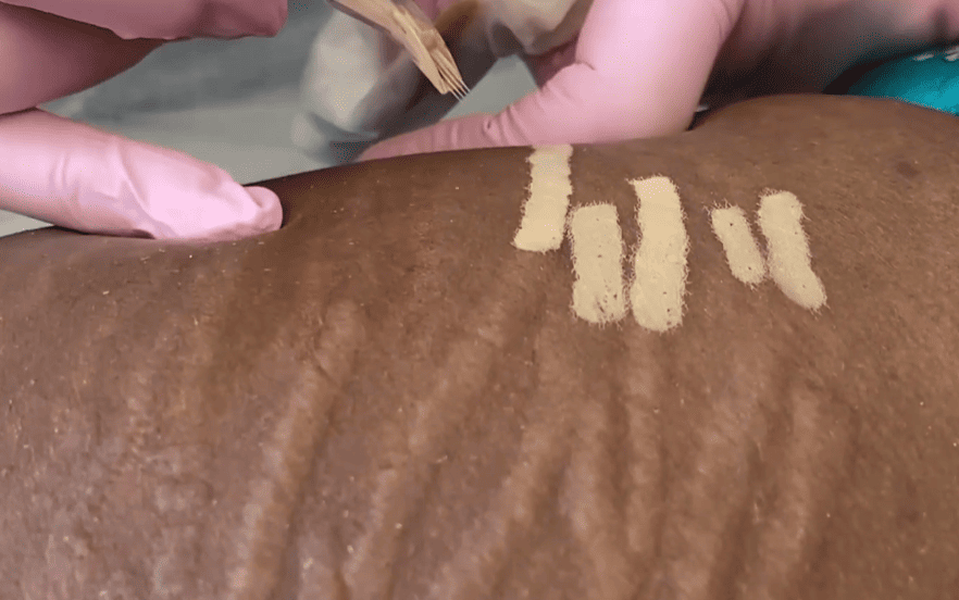 Selecting the Right Tattoo Artist for Scarred Skin